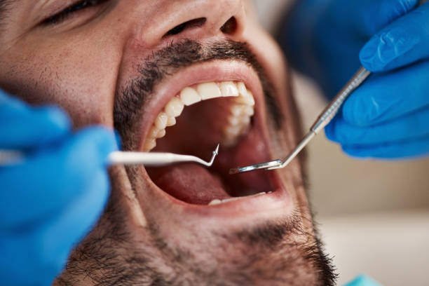 Best Wisdom Tooth Removal  in Birchwood Lakes, PA
